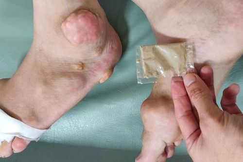 Nhiều người 'tiền mất, tật mang' vì mua thuốc ngoài chợ, trên mạng trị gout