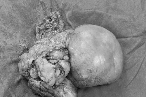 Phẫu thuật khối sarcoma mỡ sau phúc mạc khổng lồ ở bệnh nhân 76 tuổi