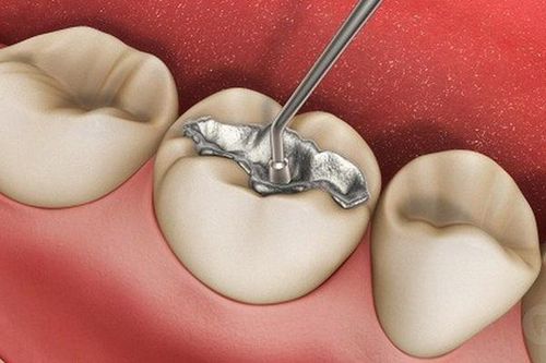 Nhiều nước kêu gọi cấm vật liệu trám răng chứa thủy ngân trước năm 2030