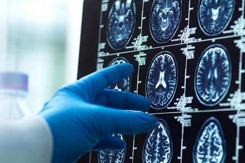 Các nhà khoa học sửng sốt vì phát hiện não người đầy vi nhựa