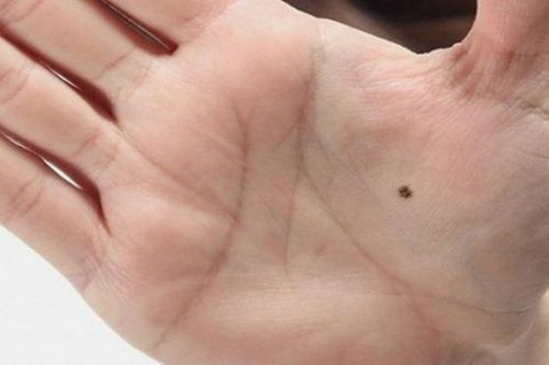4 vị trí nốt ruồi phú quý, ai sở hữu đều có cuộc đời giàu sang, phúc lộc đủ đầy