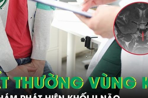 Bất ngờ phát hiện khối u ở não từ dấu hiệu bất thường vùng kín
