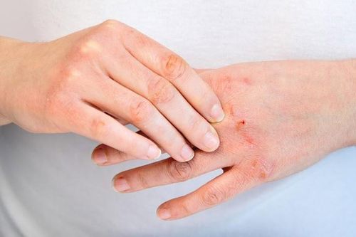 5 biện pháp hiệu quả giúp cải thiện tình trạng viêm da cơ địa