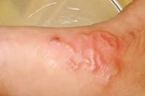 Nhiều trường hợp ở Khánh Hòa bị sán chó, người dân chủ động phòng bệnh