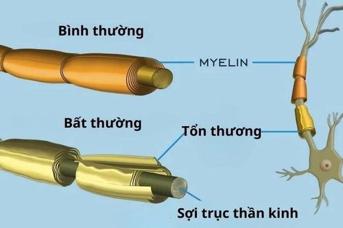 Người đàn ông ở Đắk Lắk mắc hội chứng hiếm Guillain-Barré