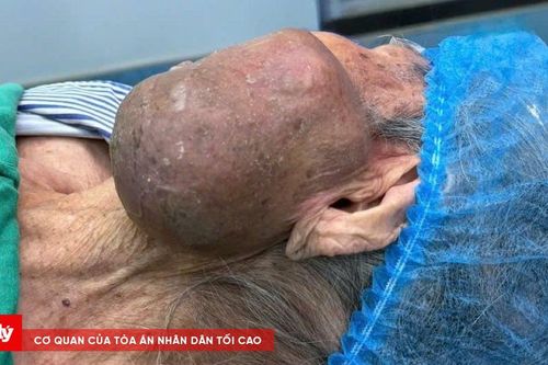 Cụ bà 99 tuổi trút được khối u 'đày đọa' trên mặt