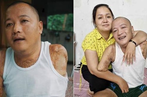 Mất 2 tay 1 chân sau tai nạn, người đàn ông tìm lại cuộc đời nhờ tình yêu của vợ