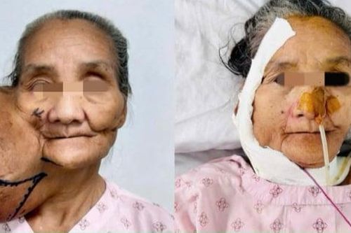 Phẫu thuật cắt thành công khối u khổng lồ trên mặt người phụ nữ 63 tuổi