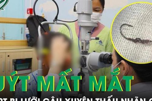 Bé trai 12 tuổi suýt mất mắt vì lưỡi câu cá xuyên thấu nhãn cầu