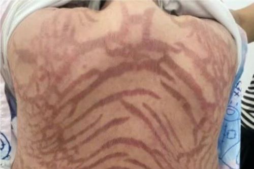 Người phụ nữ có làn da rắn sau 10 năm bôi thuốc 'thuần Đông y'