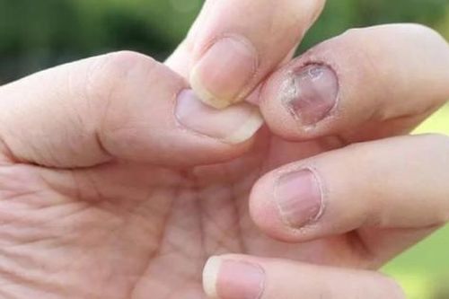 6 dấu hiệu ở móng tay cảnh báo nguy cơ mắc bệnh nguy hiểm