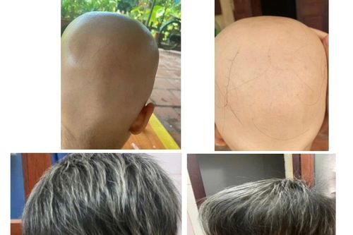 Điều trị thành công cho cháu bé 7 tuổi rụng tóc toàn thể bằng thuốc ức chế Janus kinase