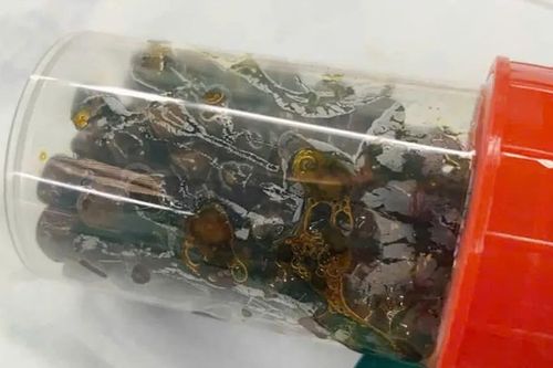 Mổ lấy hơn 100 viên sỏi trong túi mật nữ bệnh nhân