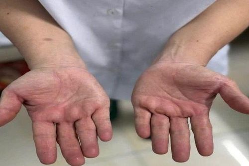Điều trị hội chứng ống cổ tay bằng phương pháp cổ truyền