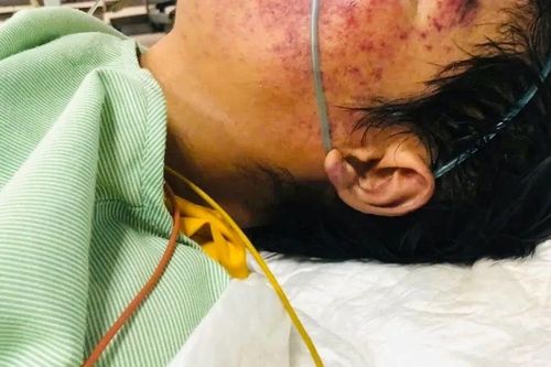 Người đàn ông ở Lạng Sơn nguy kịch do ăn 'món khoái khẩu'