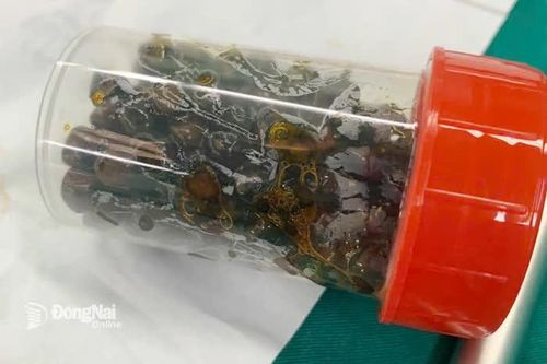 Phẫu thuật nội soi lấy hơn 100 viên sỏi trong túi mật