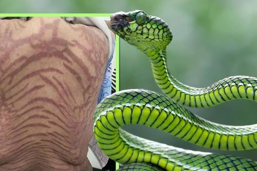 'Sốc' với làn da rắn của người phụ nữ sau 10 năm bôi thuốc 'thuần Đông y'
