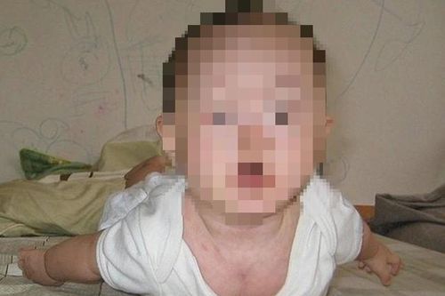 Trẻ mệt bất thường có thể mắc rối loạn nhược cơ bẩm sinh