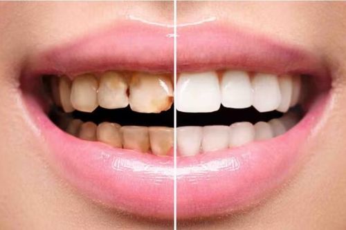 Lợi ích khi lấy cao răng, khi nào không nên lấy cao răng?