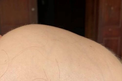 Điều trị thành công ca rụng tóc toàn bộ da đầu cho bệnh nhi 7 tuổi