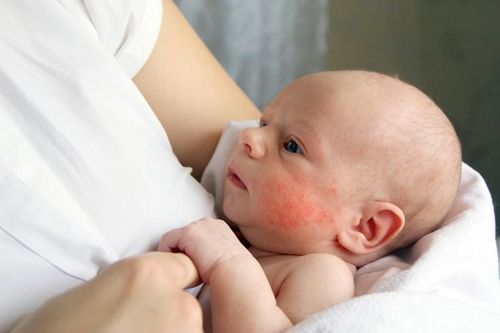 Trẻ em hay mắc các bệnh dị ứng nào?