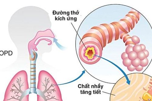 Phòng ngừa, phát hiện sớm bệnh phổi tắc nghẽn