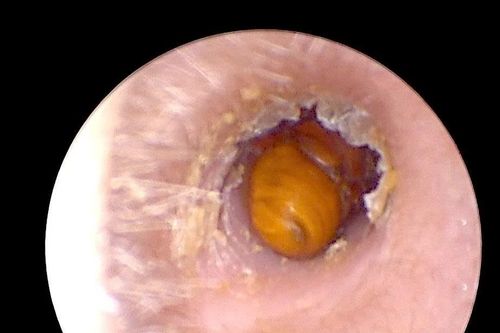 Đau nhức tai kéo dài không ngờ do côn trùng di chuyển