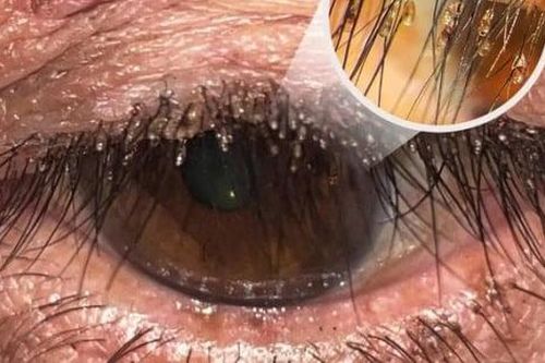 Ngứa mắt dai dẳng, cảnh báo rận mu 'làm tổ' quanh chân lông mi