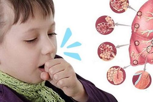 Ho kéo dài không khỏi, bé 20 tháng đi khám phát hiện viêm phổi không điển hình