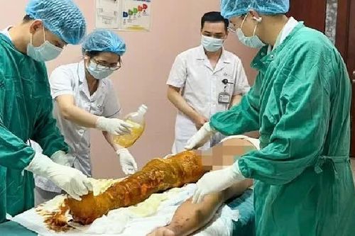 Bé trai bỏng nặng do tự làm thí nghiệm với cồn trong phòng tắm