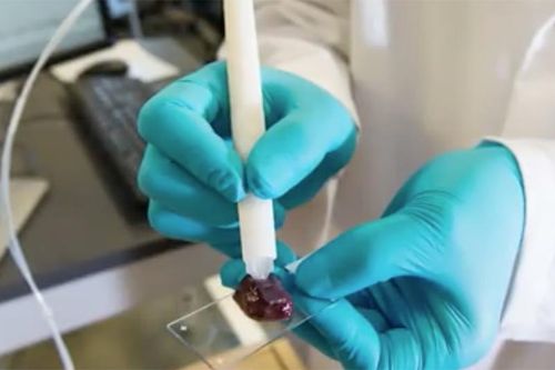 Chuyên gia Brazil phát minh thiết bị phát hiện ung thư trong 10 giây