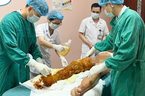 Bé 12 tuổi ở Hà Nội bỏng nặng do tự nghịch cồn trong nhà tắm