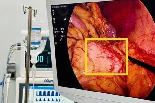 Bảo tồn lách cắt u thân – đuôi tụy giúp bệnh nhân phục hồi tốt