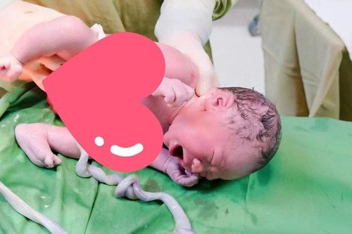 Bé trai 3,3 kg bị dây rốn thắt hai nút hiếm gặp chào đời an toàn