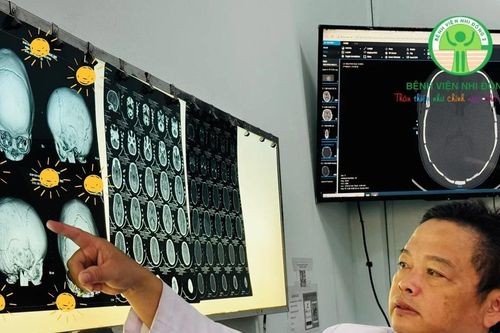 Tạo hình cho trẻ méo đầu do dính khớp sọ