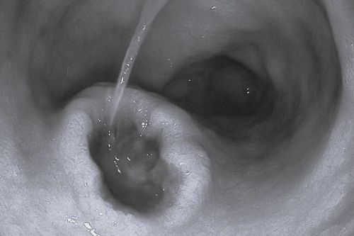 Dạ dày loét nặng vì thói quen phổ biến của người Việt khi đau