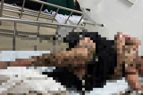 Bị bỏng nặng vì quăng dây câu cá trúng dây điện