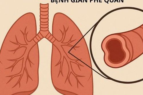 Ho ra máu cần cảnh giác với giãn phế quản