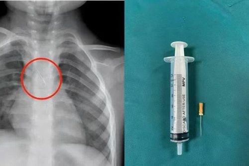 Quảng Trị: Kịp thời cứu cháu bé bị kim chọc tủy rơi vào đường thở