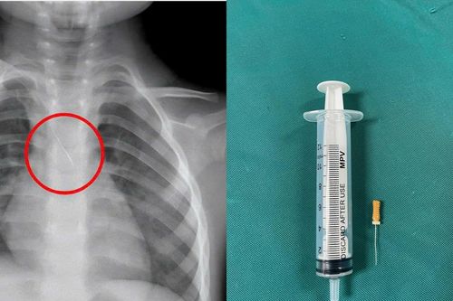 Bé 3 tuổi ở Quảng Trị bị kim chọc tủy kẹt trong đường thở