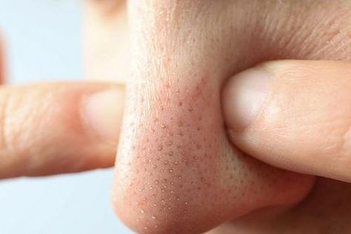 5 loại mặt nạ trị mụn đầu đen từ nguyên liệu nhà bếp giúp da mịn sạch tự nhiên