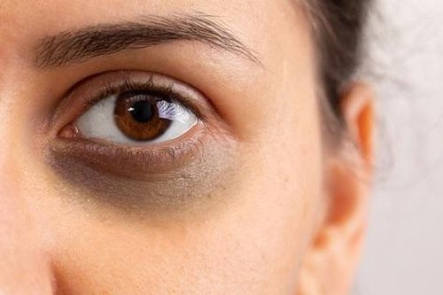 9 loại thực phẩm hỗ trợ sản xuất collagen làm mờ quầng thâm mắt tự nhiên
