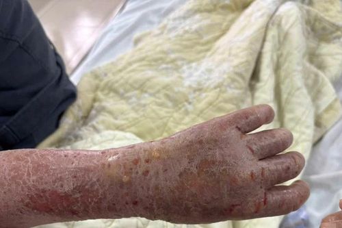 Bôi thuốc lá để chữa ngứa, cụ bà 61 tuổi nhập viện da bong vảy khắp người