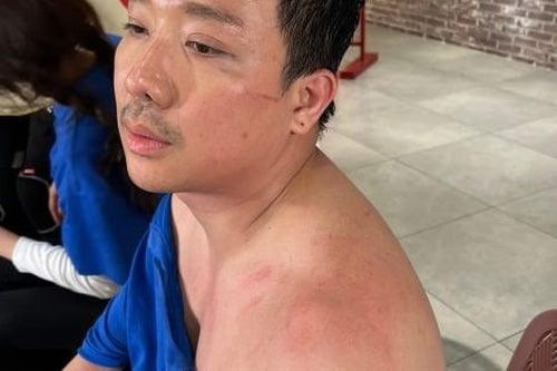 Trấn Thành lộ ảnh bầm dập, vết thương chằng chịt khắp cơ thể