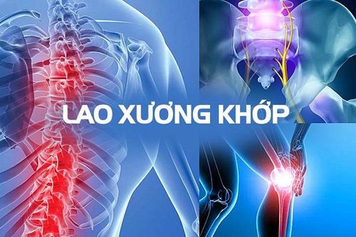 Ai là người dễ bị lao xương khớp?