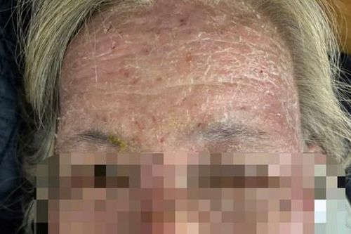 Tưởng có 'sâu bò', người phụ nữ tự điều trị bằng thuốc lá, suýt nguy kịch