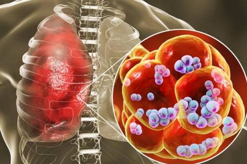 Phế cầu khuẩn gây ra nhiều bệnh nguy hiểm