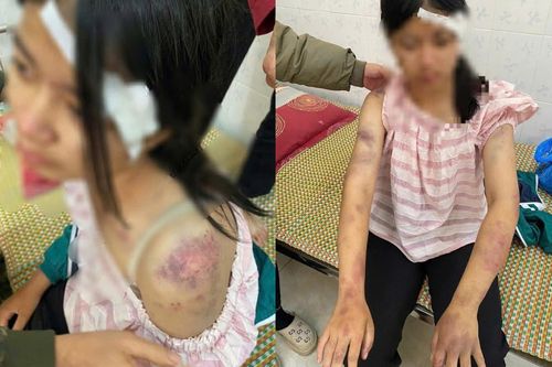 Bé gái bị người nhà đánh đập, tra tấn dã man vì nghi trộm tiền
