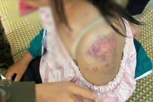 Bé gái 13 tuổi bị bà nội và hai người ông tra khảo, đánh đập dã man vì nghi trộm tiền