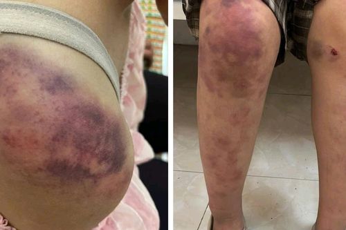 Mẹ bé gái bị bạo hành ở Thái Nguyên: 'Con tôi bị đánh suốt 4 tiếng liên tục, 2h sáng mới chạy thoát'
